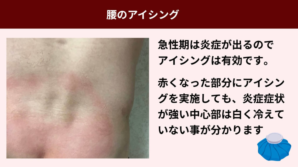 ミズノ治療院_ぎっくり腰_アイシング