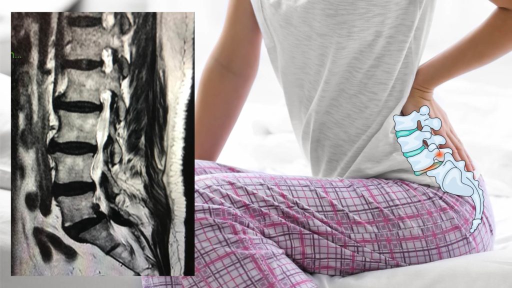 ミズノ治療院_腰椎すべり症