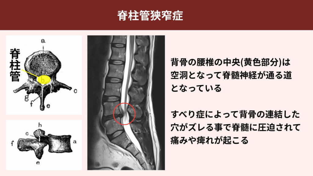 ミズノ治療院_脊柱管狭窄症