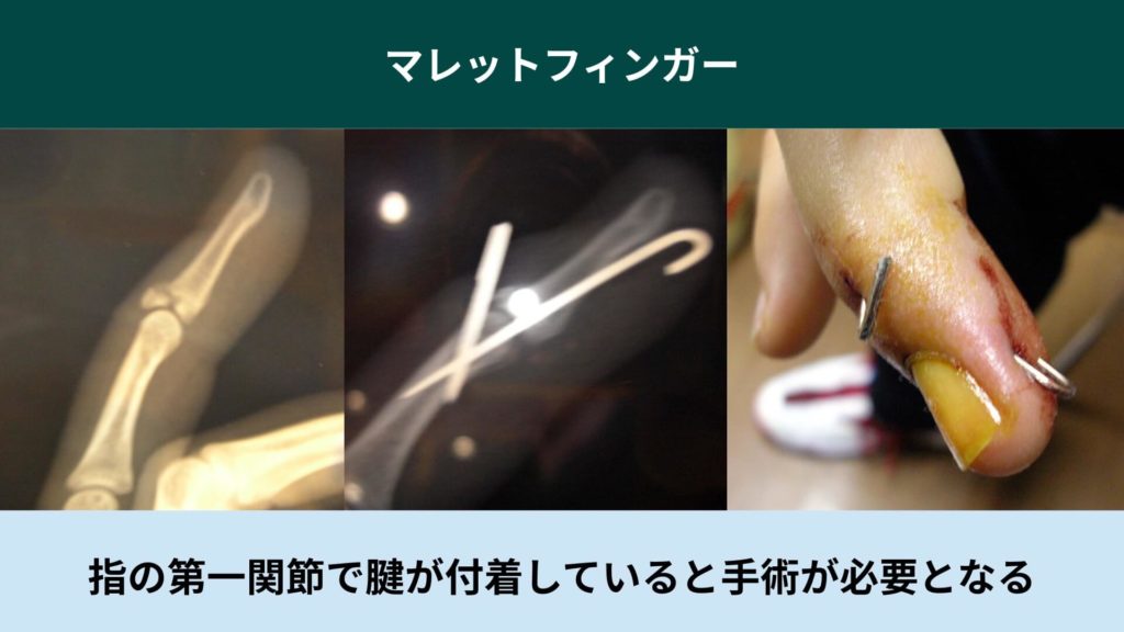 マレットフィンガー_バスケ