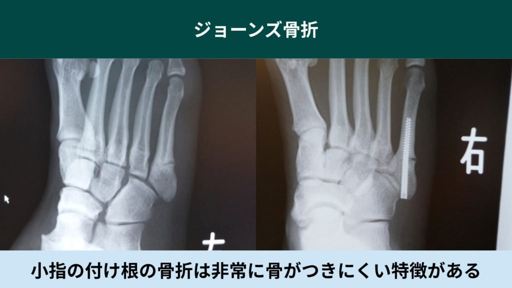 ジョーンズ骨折_バスケ_ミズノ治療院