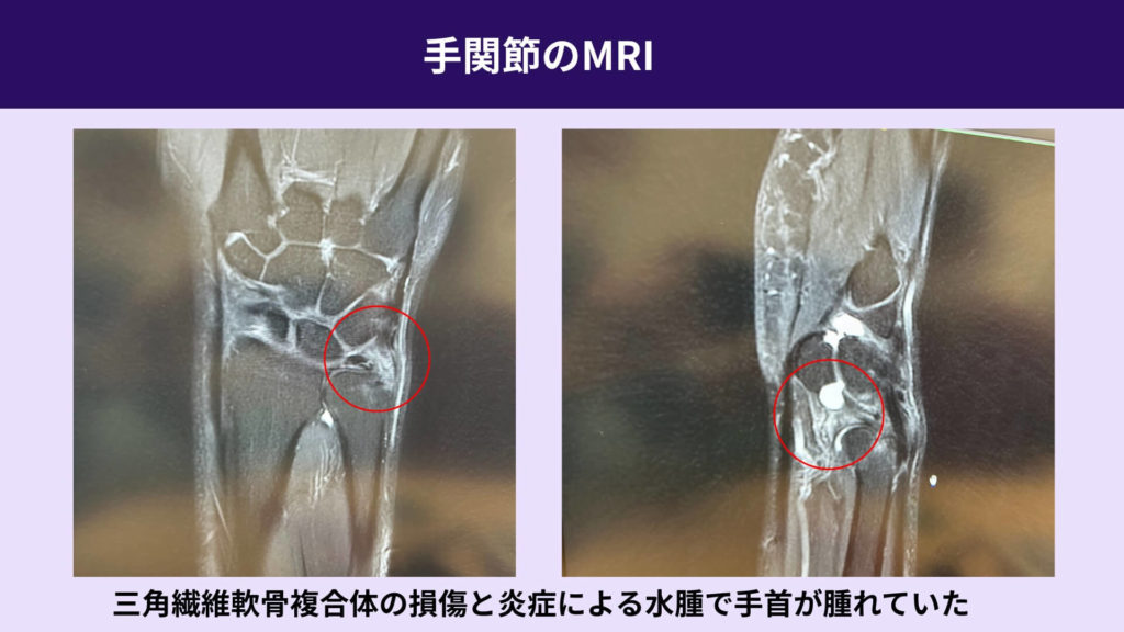 手首MRI_TFCC_バスケ