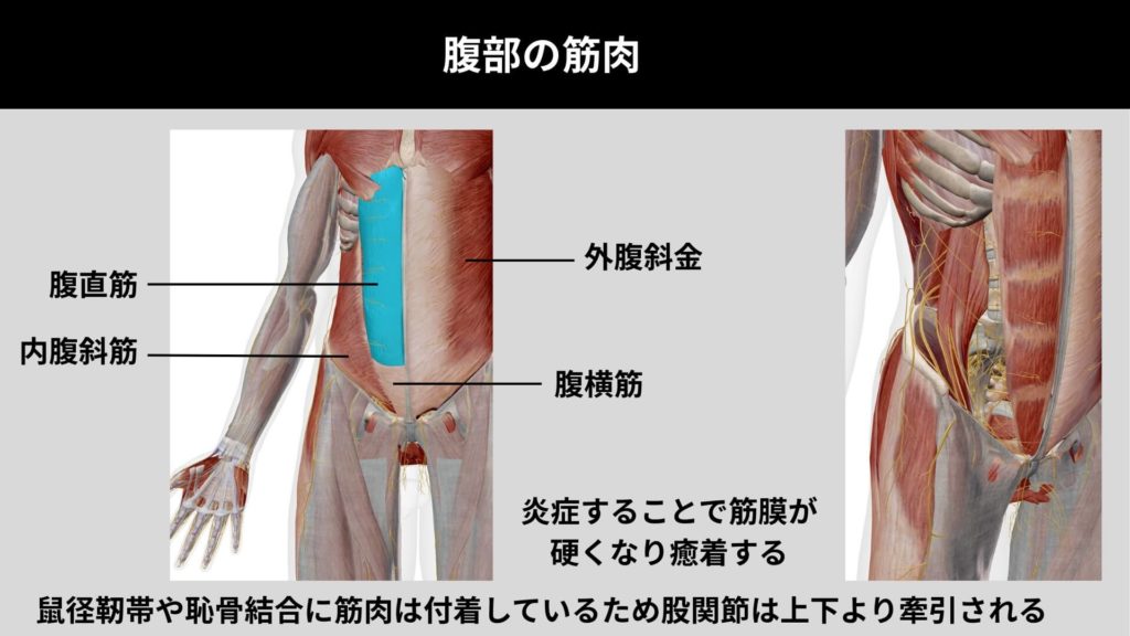 ミズノ治療院_鼠径部痛症候群