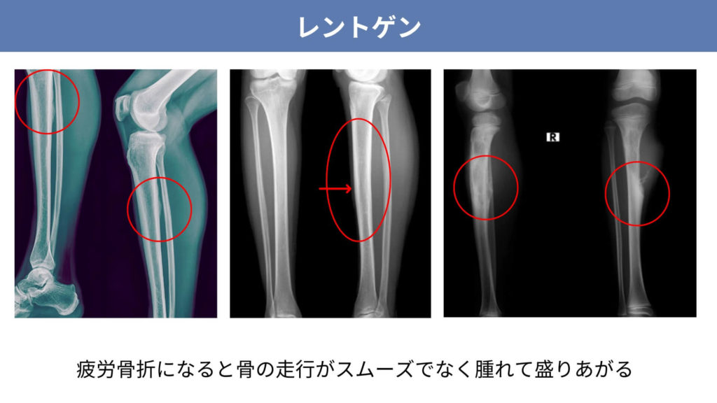 ミズノ治療院_シンスプリント